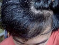 Penyebab Rambut Putih Pada Usia Muda: Fakta dan Solusinya